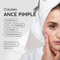 Acne Pimple Face Toner